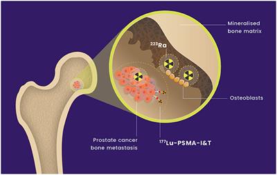 AlphaBet: Combination of Radium-223 and [177Lu]Lu-PSMA-I&T in men with metastatic castration-resistant prostate cancer (clinical trial protocol)